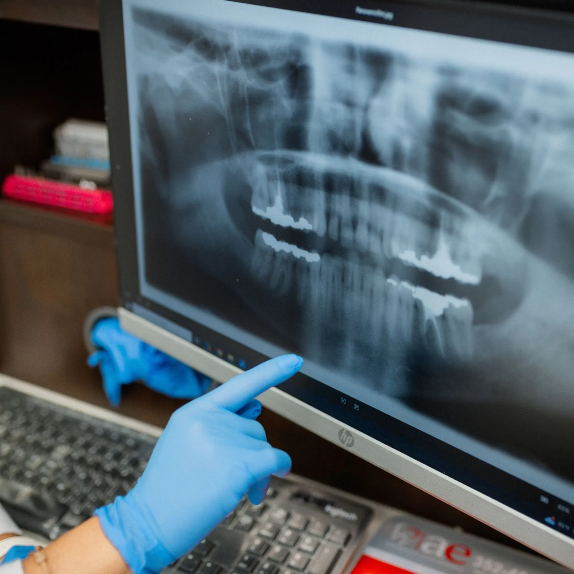 Gloved hand pointing out bone levels around the teeth on a panoramic X-ray